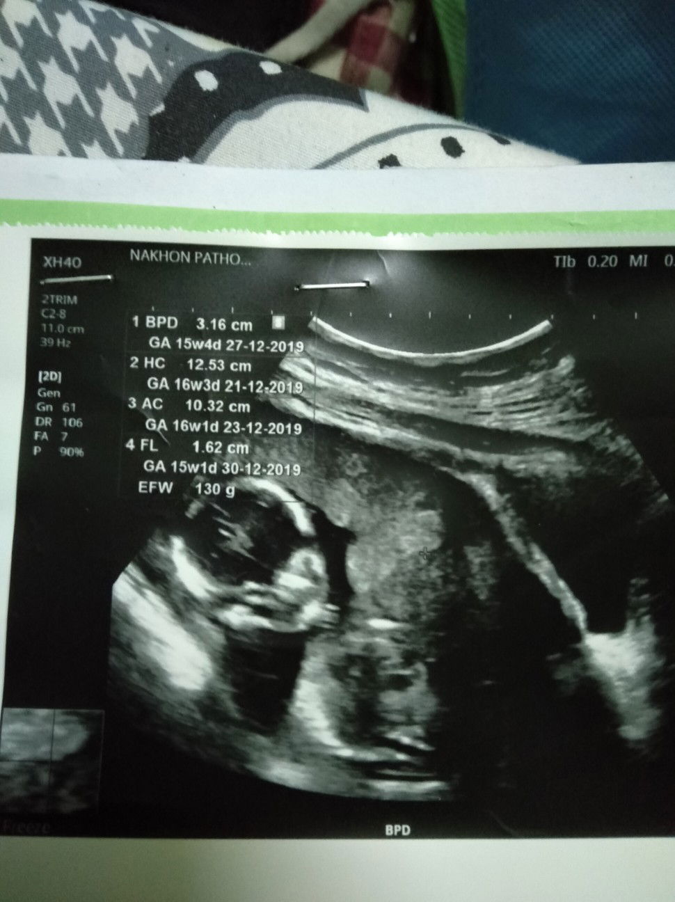 อยากทราบค่ะว่าผลแบบนี้ปกติมั้ยรบกวนแม่ๆที่มีประสบการณ์ค่ะ