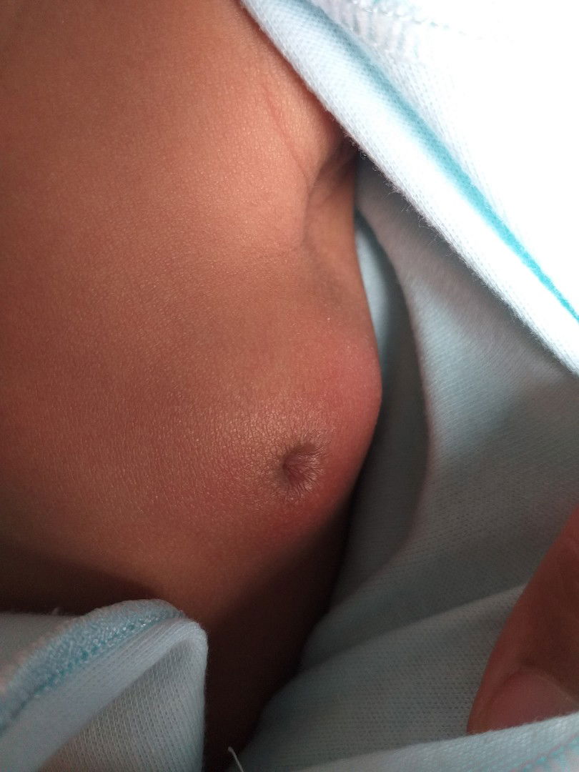 payudara bayi bengkak