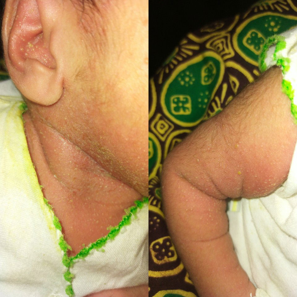 Beruntusan Newborn 2 minggu