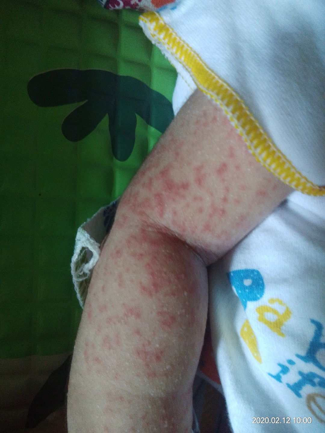 Merah-merah ditangan