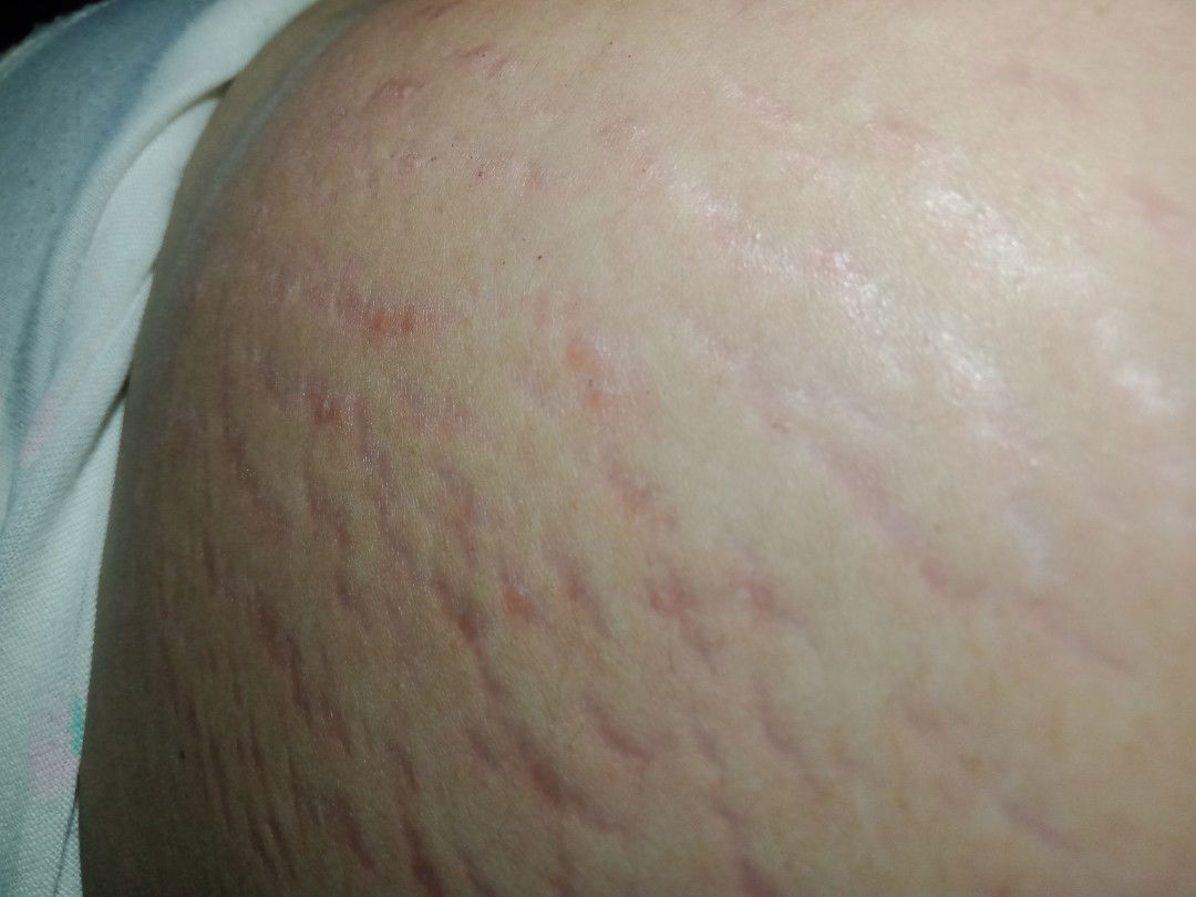 Gatal gatal di perrut dan di bagian² lipatan kaki