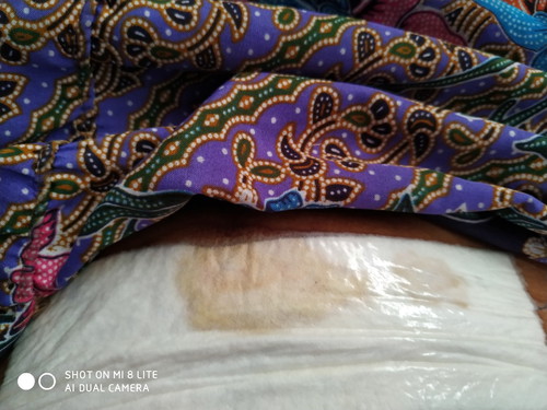 เเผลผ่าคลอด