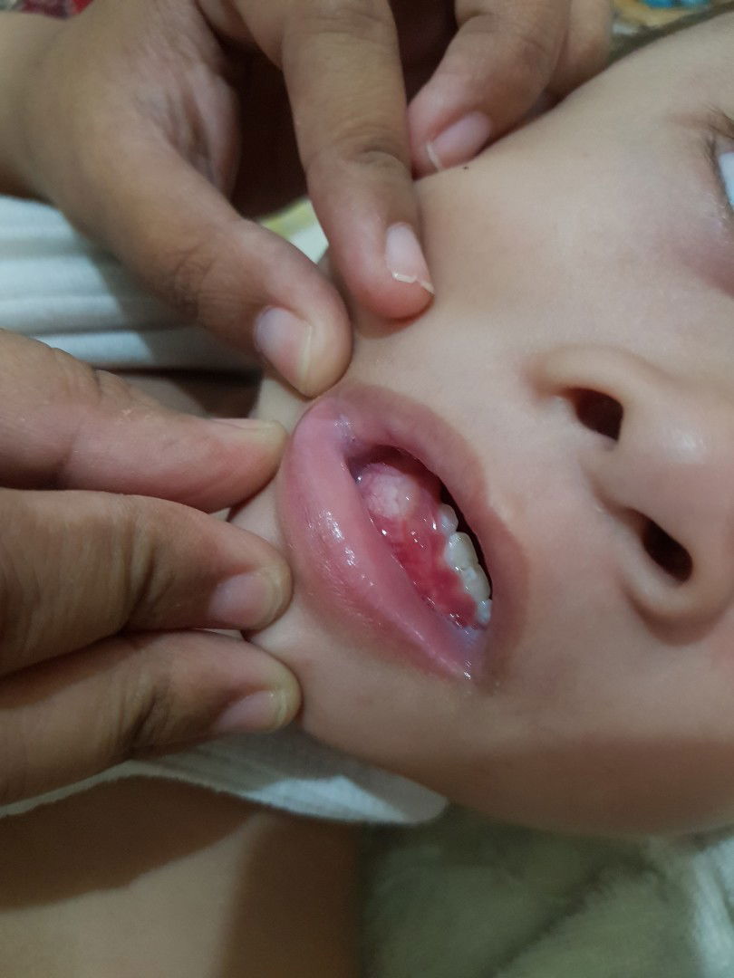 MAU TUMBUH GIGI KAH?