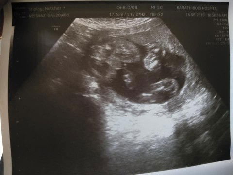 กิจกรรมแจกรถเข็นเด็ก