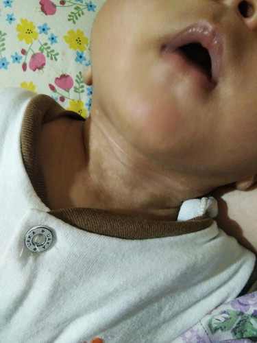 bercak putih spt panu pada bayi