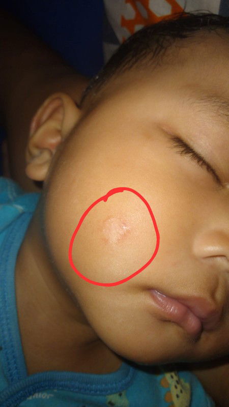 Assalamualaikum,Bun info dong cream buat obatinya pake sebamed ga mempan