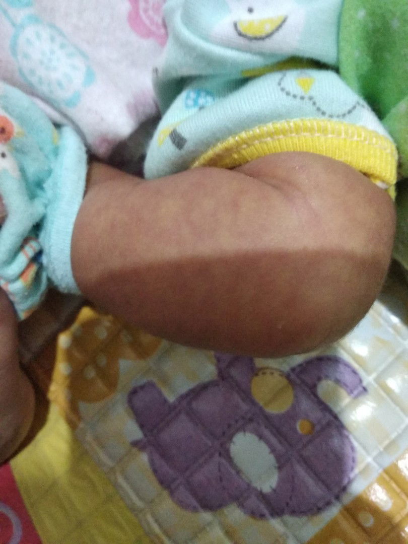 kulit bayi keunguan