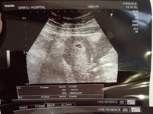 ท้องแรกแท้ง