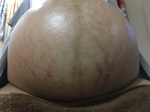 ท้องลาย