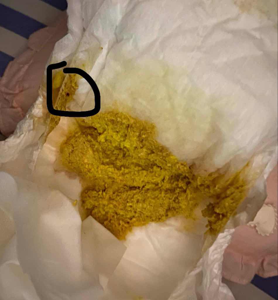 อุจาระแบบนี้ปกติมั้ยคะ