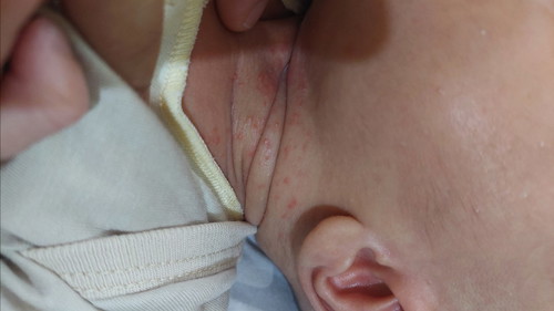 RUAM-BINTIK Di leher bayi
