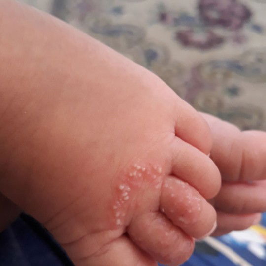 ruam kaki atau apa ?