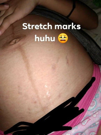 stretch marks