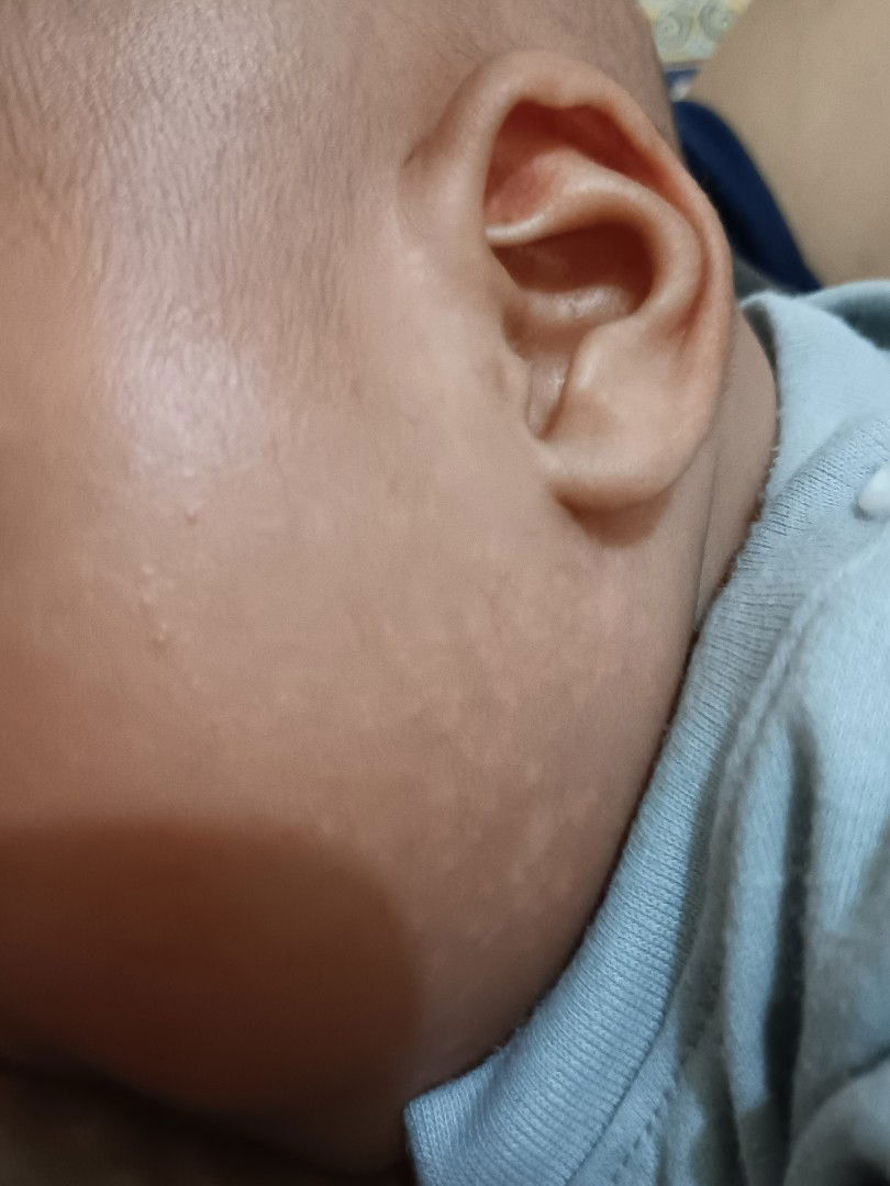 Bintik putih kya panu diwajah