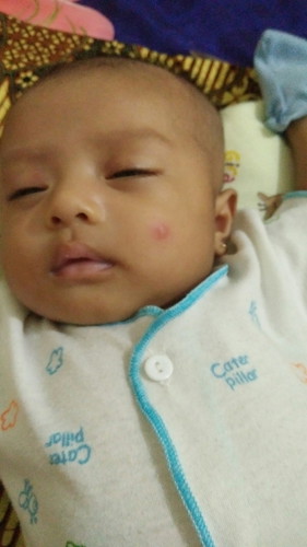 di gigit nyamuk