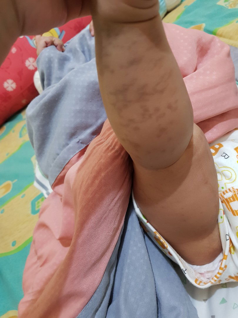 alhamdulillah bentol2 tdk muncul baru lagi, kata org penyakit sawan