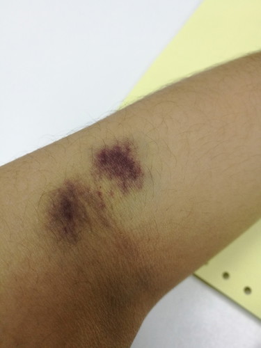lengan lebam lepas kena cucuk