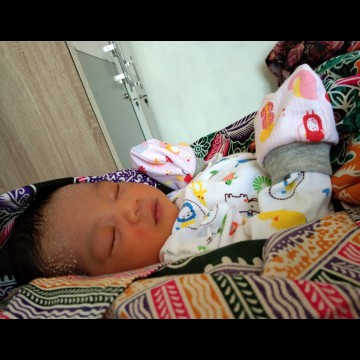 jerawat bayi