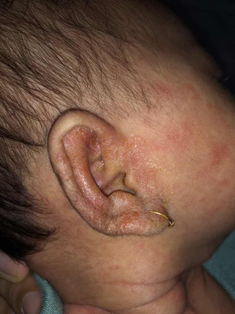 bayi 30 hari telinganya kering begini, seperti beruntusan yang sudah pecah