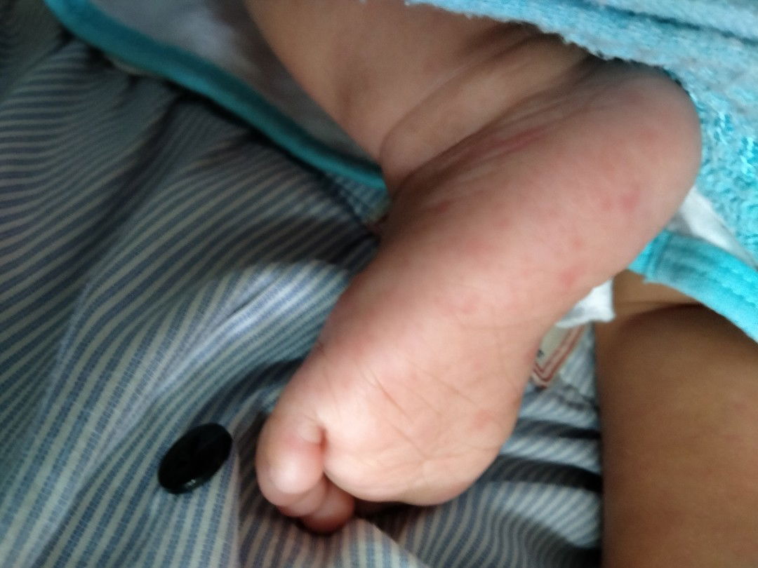 ไข้มีตุ่ม