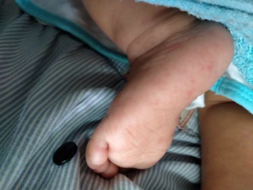 ไข้มีตุ่ม