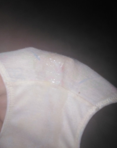 Mucus Plug Or White Discharge Only?