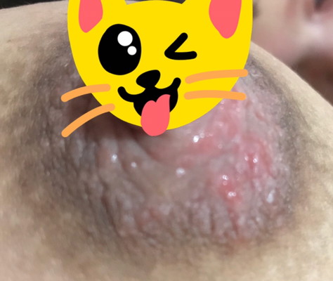 นมมันเป็นแบบนี้อะไร ใครเป็นบ้าง(น่ากลัวนิดๆนะคะ(