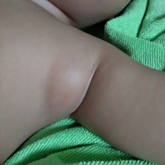 benjolan di ketiak bayi