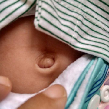 Pusar bayi sedikit berdarah