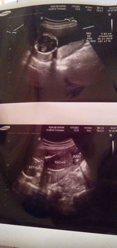 Alhandulillah bun Udah ngerasain USG pertama .dan jadi pgen lagi