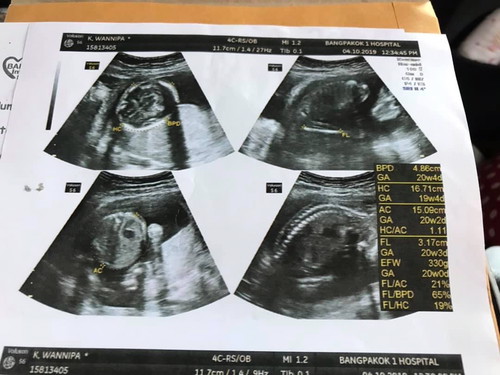 20วีค หนูน้อยน้ำหนักเท่าไหร่กันแล้วค่ะ