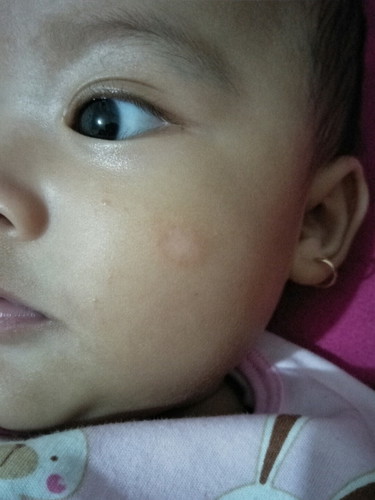 ini apa ruam? dan bagaimana mengobatinya udah di kasih babu cream sama salep dri Bidan masih tetap aja?