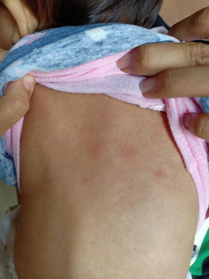 Anakku umur 10 bulan Kulitnya merah dan kering kayak ngriput gitu kenapa iya?