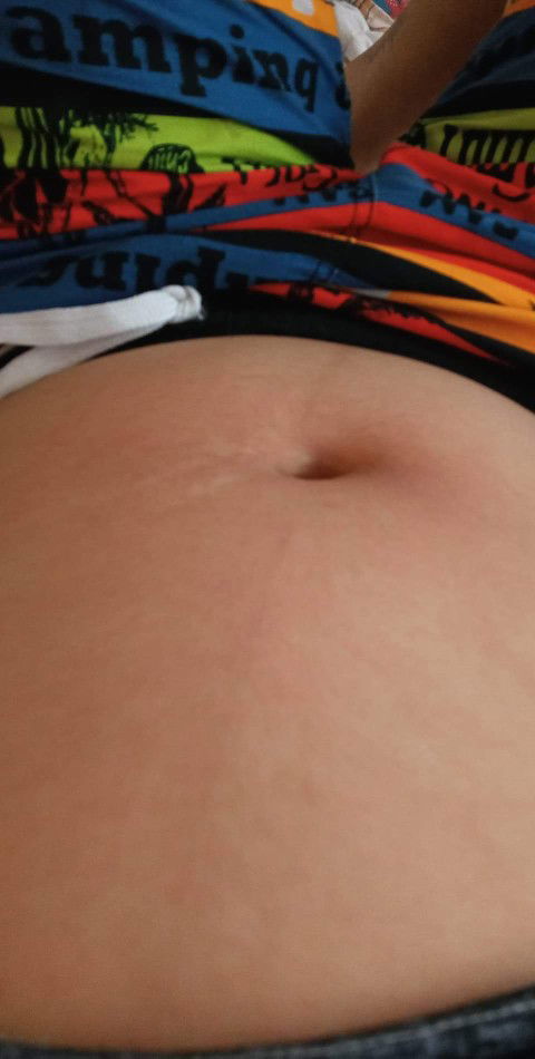 ท้องแตกลาย