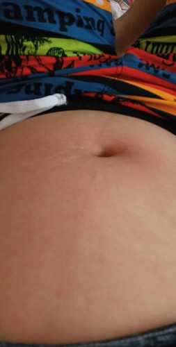 ท้องแตกลาย