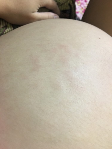 ผื่นคัน