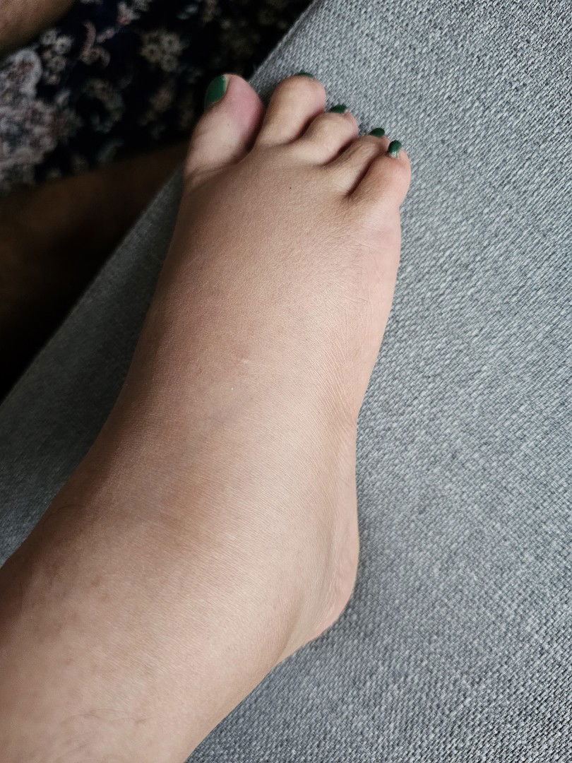 Swollen legs but normal Bp and pulse in 34 weeks