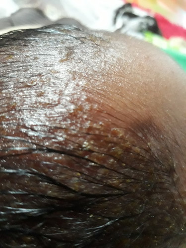 ruam d kepala
