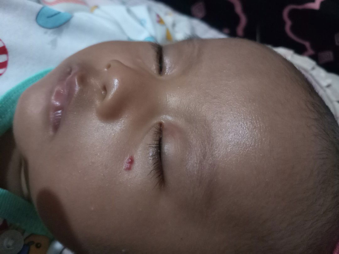 bintik merah diwajah bayi