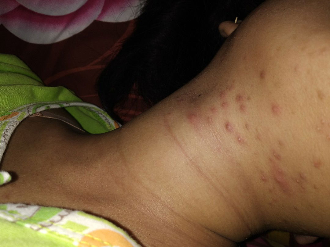 gatal-gatal