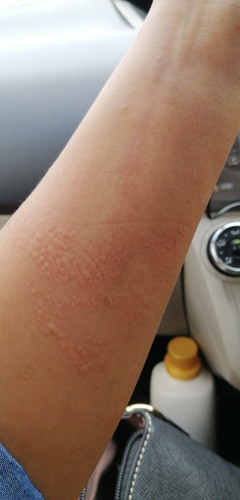 Gatal Kulit Selepas Bersalin