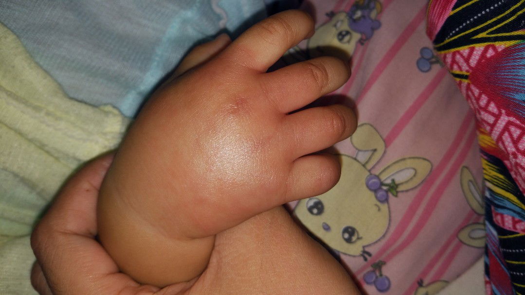 tangan bengkak tibatiba..