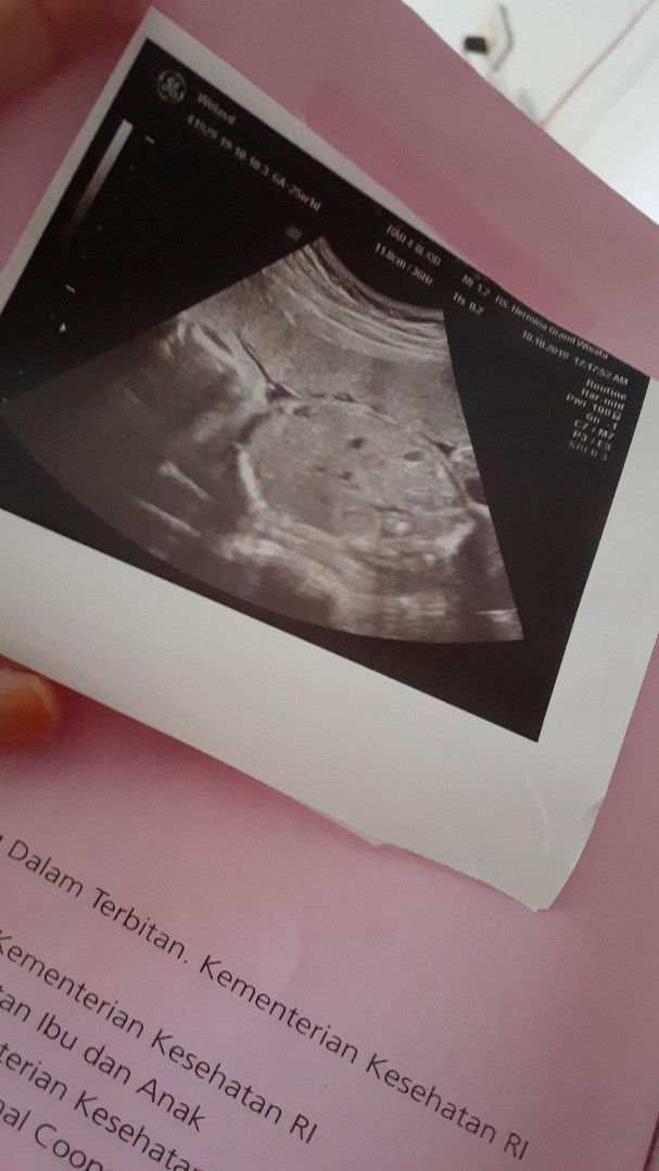 24w kurang ketuban debay sungsang