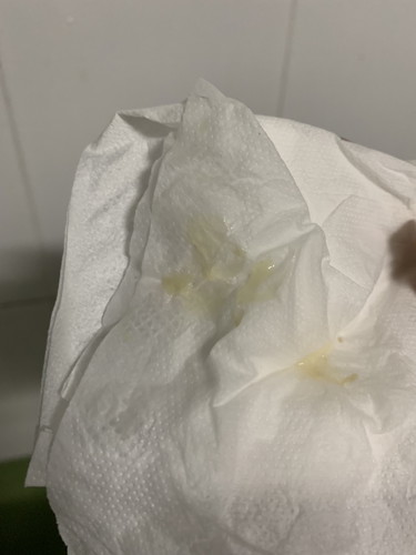 มูกใสแบบนี้ใกล้คลอดมั้ยคะ