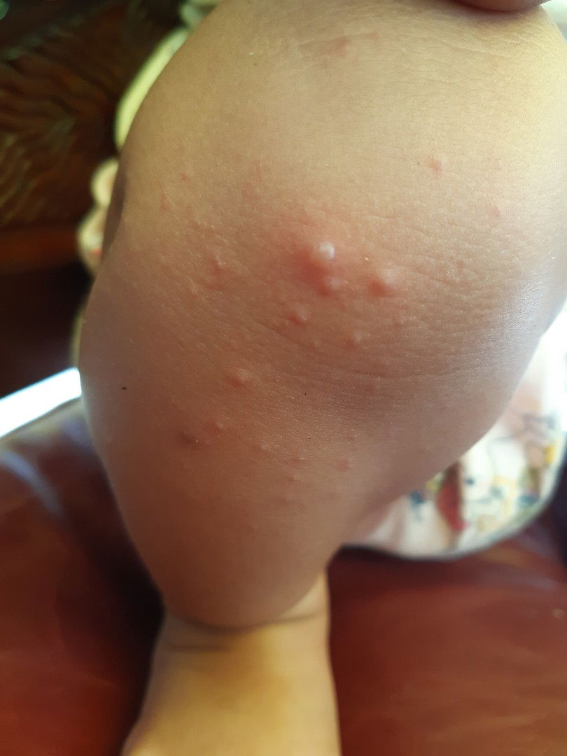 pnas n ruam kmerahan