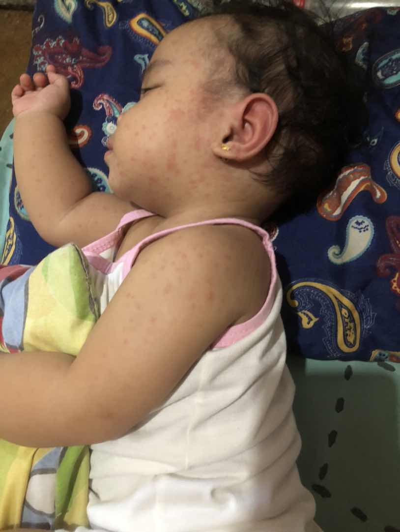 Rashes after niya lagnatin