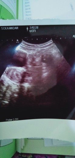 hamil 4 Minggu 3hari