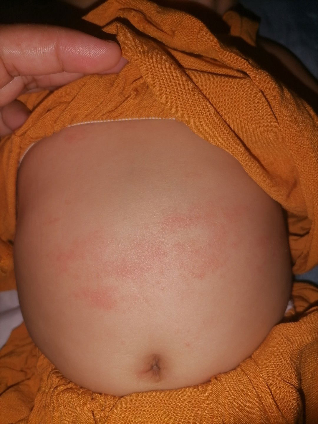 rashes sa tiyan ni baby dumadami anong mabisang gamot.