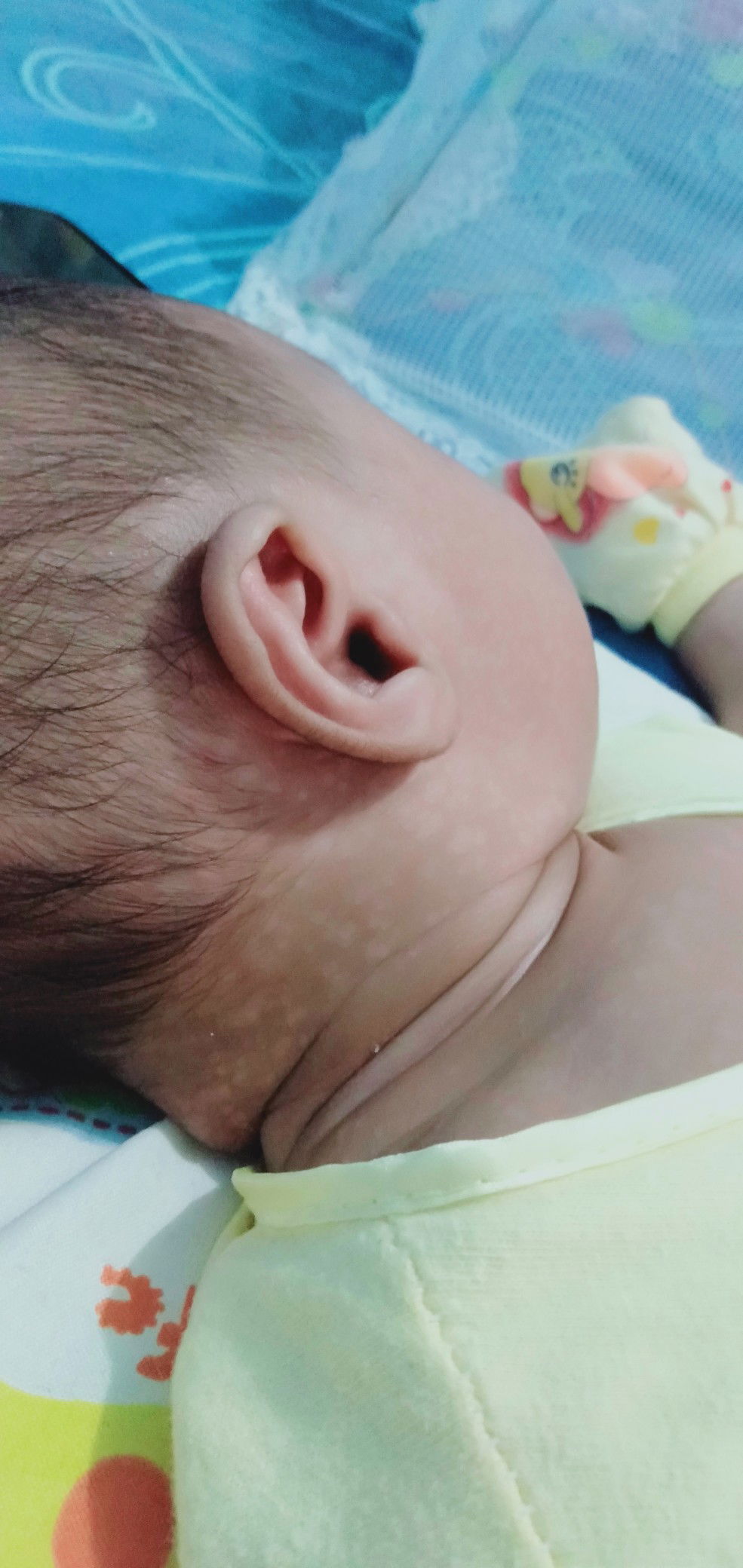 kulit bayi bercak putih