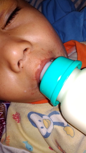 Ini Kenapa Yah Bund Apakah Herpes, Alergi, Flu Singapore,